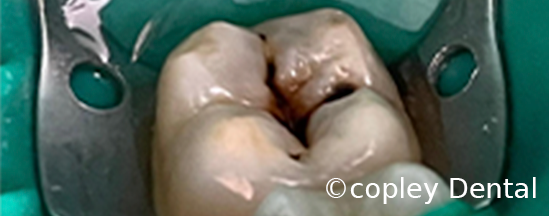 CASE 10: Cosmetic Dentistry – White Dental Filling - Before