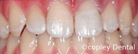 CASE 40: Emergency Treatment – Fractured Tooth - After