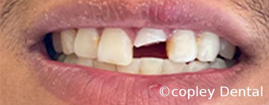 CASE 47: Fractured Tooth - Before