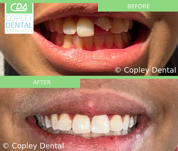 CASE 54: Fractured Tooth