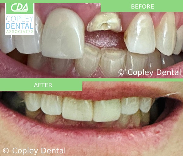 CASE 55: Fractured Tooth