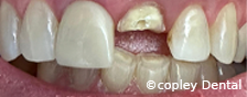 CASE 55: Fractured Tooth - Before