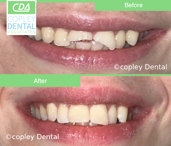 CASE 57: Fractured Tooth