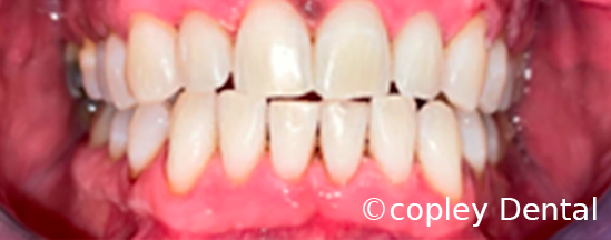CASE 60: Cosmetic Dentistry – Teeth Whitening - After