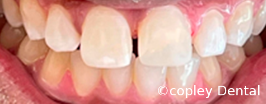 CASE 61: Fractured Tooth - After