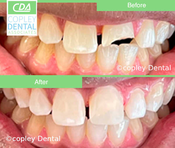CASE 61: Fractured Tooth