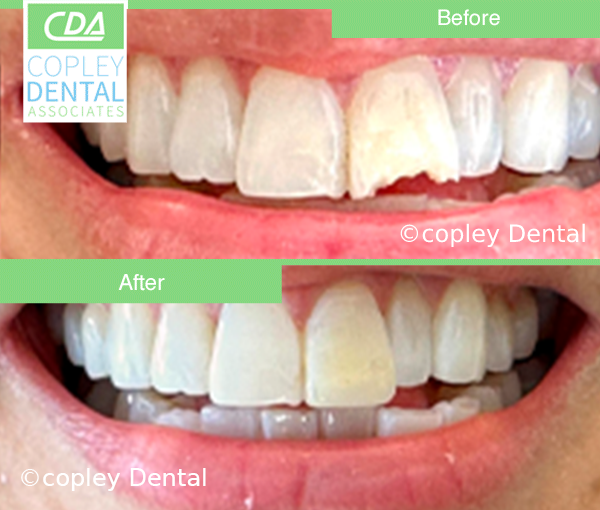 CASE 62: Fractured Tooth