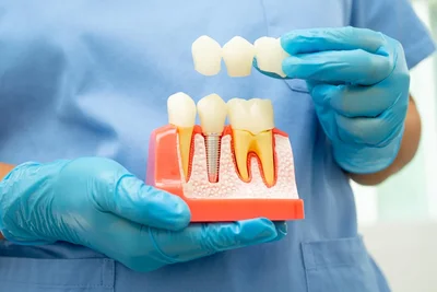 Dental Implant Procedure
