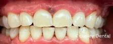 CASE 45: Cosmetic Dentistry - After
