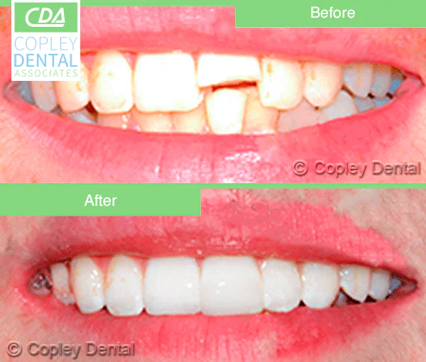 CASE 1: Emergency Treatment – Fractured Tooth