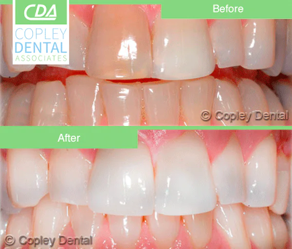 CASE 12: Veneers – Stained Teeth