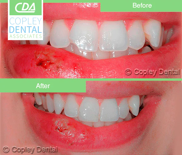 CASE 15: Emergency Dentist – Fractured Tooth