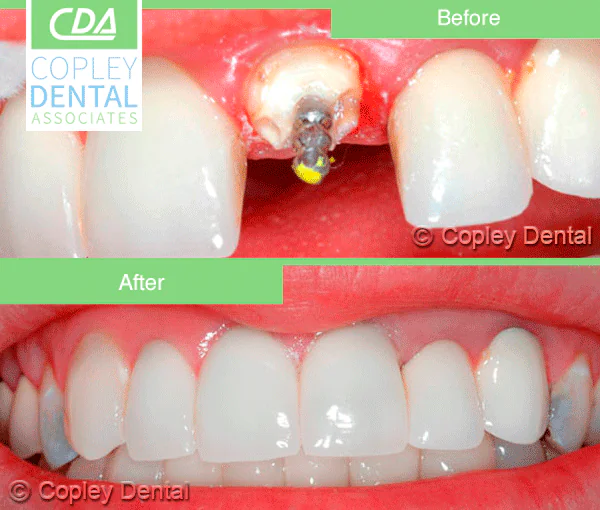 CASE 19: Emergency Treatment – Fractured Tooth