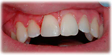 CASE 20: Broken Fractured Tooth - After