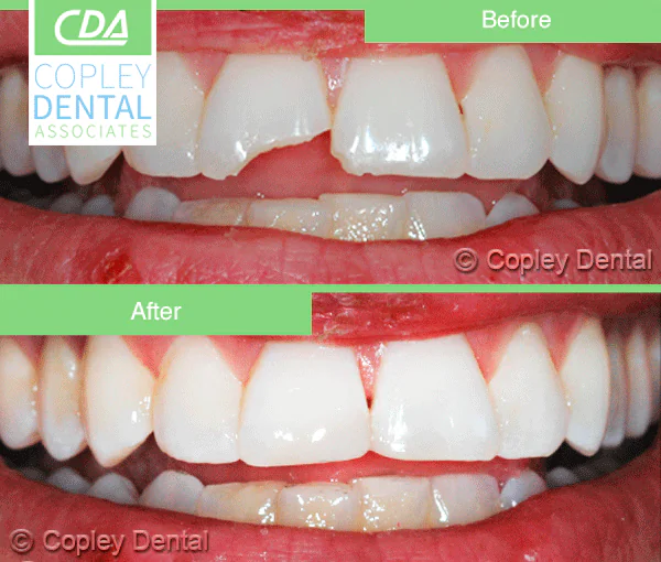 CASE 20: Broken Fractured Tooth