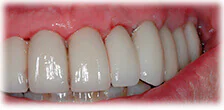CASE 22: Cosmetic Restoration - After