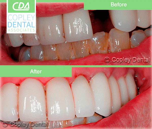 CASE 22: Cosmetic Restoration