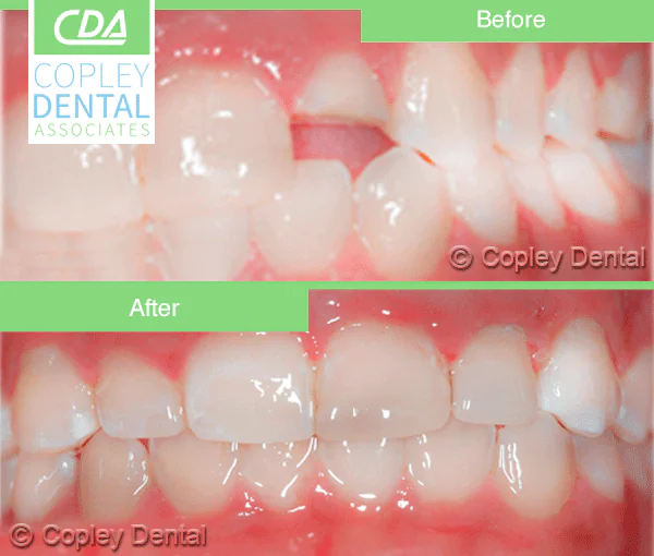 CASE 25: Emergency Treatment – Fractured Tooth