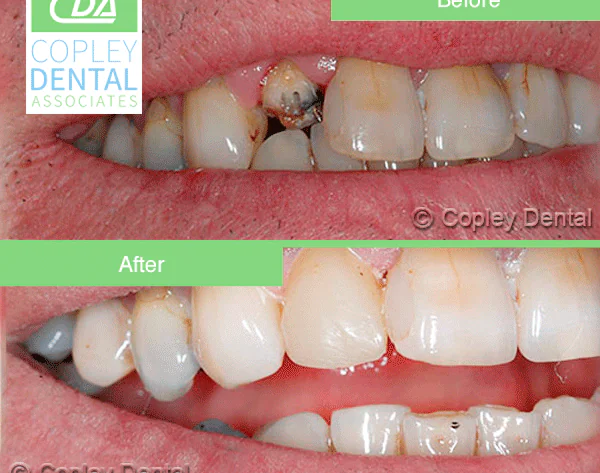 CASE 26: Broken Fractured Tooth