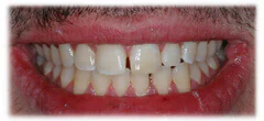 CASE 29: Emergency Treatment – Broken Teeth - After