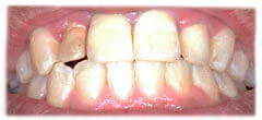 CASE 31: Cosmetic Restoration - Before