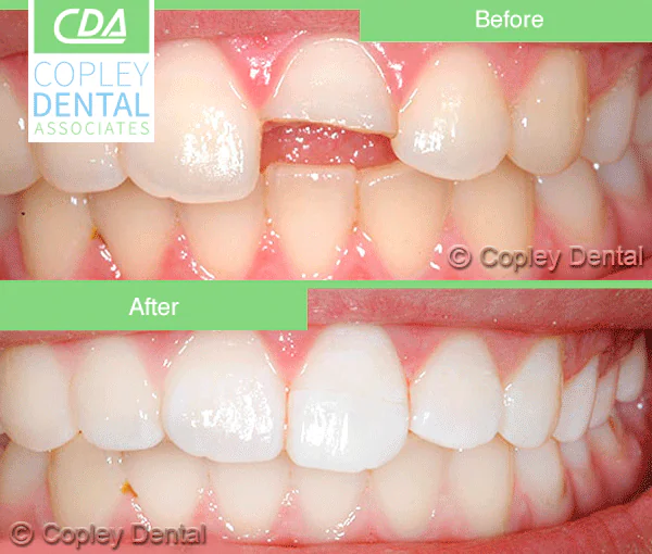 CASE 32: Broken Fractured Tooth