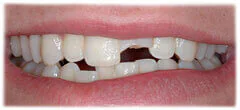 CASE 35: Broken Fractured Tooth - Before