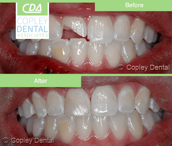 CASE 39: Emergency Treatment – Broken Tooth