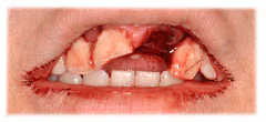 CASE 41: Emergency Treatment – Fractured Tooth - Before