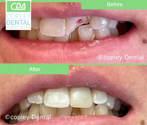 CASE 44: Fractured Tooth