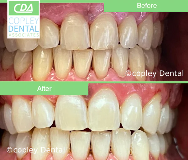 CASE 45: Cosmetic Dentistry
