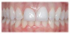 CASE 6: Cosmetic Dentistry – Porcelain Crowns - After