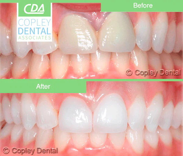CASE 6: Cosmetic Dentistry – Porcelain Crowns