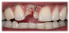 CASE 7: Emergency Treatment – Fractured Tooth - Before