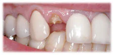 CASE 9: Emergency Treatment – Fractured Tooth - Before