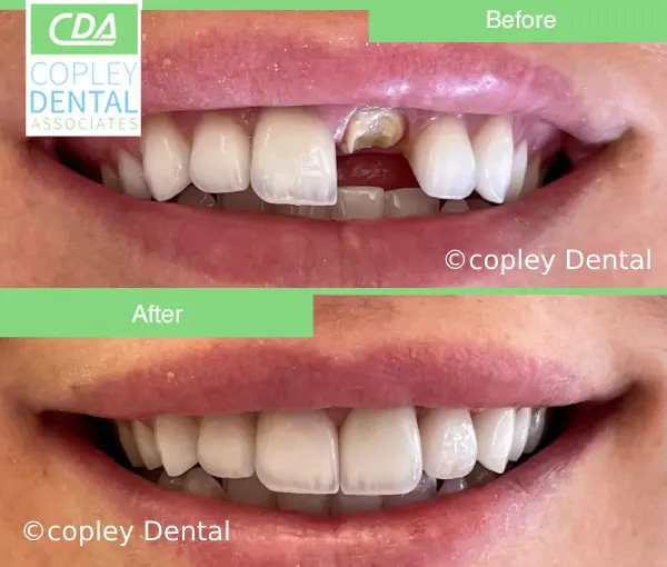 CASE 46: Emergency Treatment – Fractured Tooth