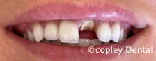 CASE 46: Emergency Treatment – Fractured Tooth - Before