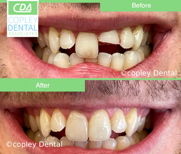 CASE 48: Fractured Tooth